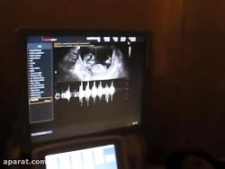 سونوگرافی هفته 12 حاملگی  910918  pregnancy ultrasound Week 12