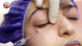 جدیدترین متد برای درمان تیرگی گودی زیر چشم بدون هیچ گونه عارضه جانبی