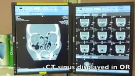 Nasal Polyposis  FESS   MEDtube.net.mp4