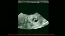 Ectopic Pregnancy   MEDtube.net.mp4