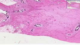 Gynecomastia  Histopathology  Breast   MEDtube.net.mp