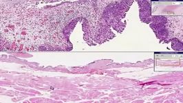 TCC Transitional Cell Carcinoma