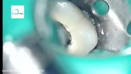 Endodontic Retreatment Molar