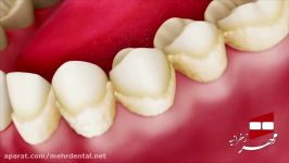 انیمیشن جرمگیری دندان  کلینیک دندانپزشکی مهر زعفرانیه