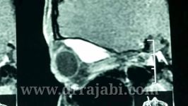 جراحی تومور بزرگ كاسه چشم در كودك ١٤ساله