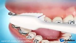 روش صحیح مسواک زدن دندانهای ارتودنسی