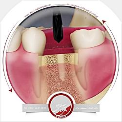 انیمیشن ایمپلنت دندان  دکتر اشکان مصطفی نژاد