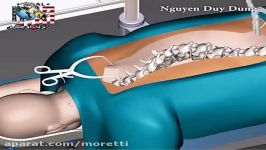 درمان انحنای انحراف کجی ستون فقرات عمل جراحی