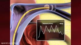 Swan Ganz Catheter Placement Animation