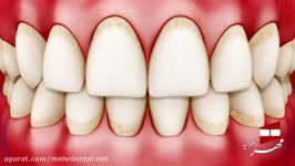 انیمیشن بیماری ژنژویت  کلینیک دندانپزشکی مهر زعفرانیه