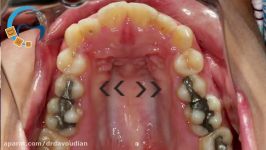 کشیدن دندان در ارتودنسی  دکتر مسعود داوودیان