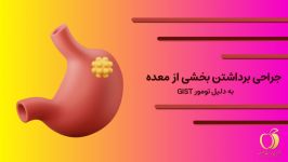 فیلم عمل جراحی برداشتن بخشی معده به دلیل تومور GIST