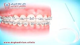 طریقه استفاده نخ دندان در حین درمان ارتودنسى