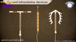 نحوه قرارگیری IUd