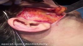 Removing buccal fat