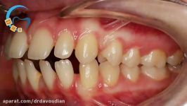 ارتودنسی بدون کشیدن دندان  دکتر مسعود داوودیان