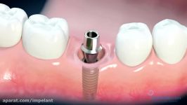 How do dental implants work