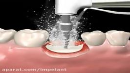 Step by step dental implant surgery. Gary R. OBrien D.D.S.