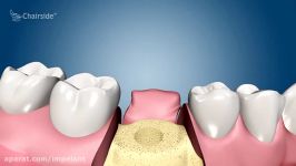 Dental Implant Procedure  Two Stage