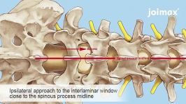 Dorsal and dorso lateral spine endoscopic for stenosis