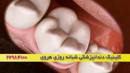 فیلم فیشور سیلانت شیار بندی دندان