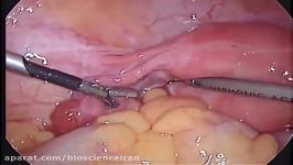 Ectopic Pregnancy  Laparoscopic Salpingectomy + Appendicectomy