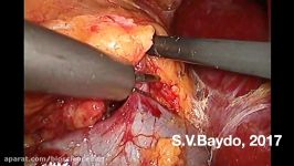 Laparoscopic nephrectomy less than 20 min