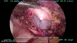 Total Laparoscopic Hysterectomy