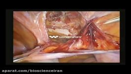 Laparoscopic inguinal hernia repair