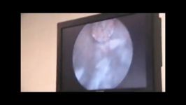 درمان سنگ بزرگ مثانه به روش آندوسکوپی توسط دکتر کرمی
