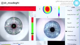 رفع عیوب انکساری چشم لیزر اگزایمر