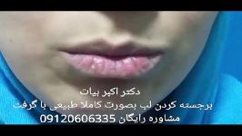 برجسته کردن لبها جراحی زیبایی لب