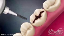 انیمیشن دندانپزشکی پرکردن دندان  دندانستان