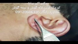 جراحی کوچک کردن سایز گوش  جراحی زیبایی گوش