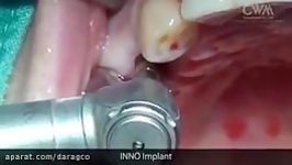 Flapless Implantation