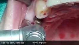 Flapless Implantation