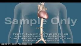 Aortic Aneurysm and Aortic Dissection