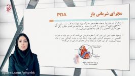 مجرای شریانی باز یا PDA