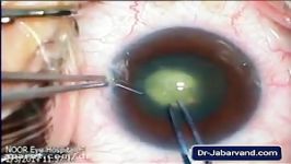 cataract  آب مروارید