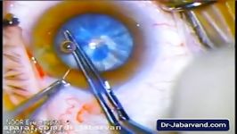 cataract  آب مروارید