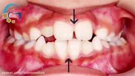 قبل بعد ارتودنسی انحراف میدلاین  دکتر مسعود داودیان