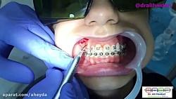 برداشتن لثه دندان نیش نهفته بالیزردایود،دکتر علی حیدری