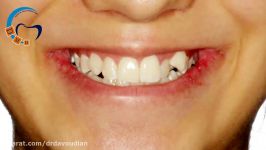 ارتودنسی دیمون بدون کشیدن دندان  دکتر مسعود داوودیان