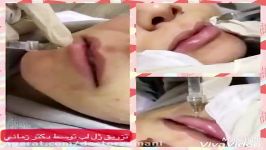 حجم دهی اصلاح لب تزریق فیلر