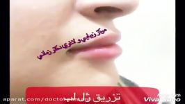 برجسته سازی اصلاح لب تزریق ژل هیالورونیک اسید