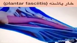 خارپاشنهPlantar fasciitisمشاوره فیزیوتراپی09122655648