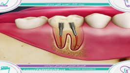 روت کانال عصب کشی  دندانپزشکی سیمادنت