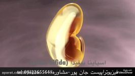 اسپاینا بیفیداSpina bifidaدرمان فیزیوتراپی09122655648