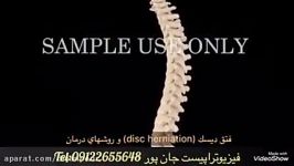 انیمیشن دیدنی فتق دیسك disc herniation روشهای مهم درمان. tel09122655648