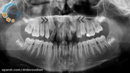 ارتودنسی انحراف میدلاین نیش نهفته دکتر مسعود داودیان